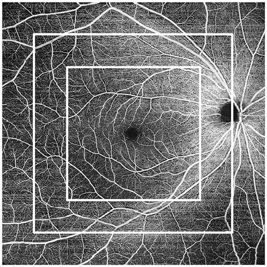 NIDEK-OCT-RS-1-Glauvas