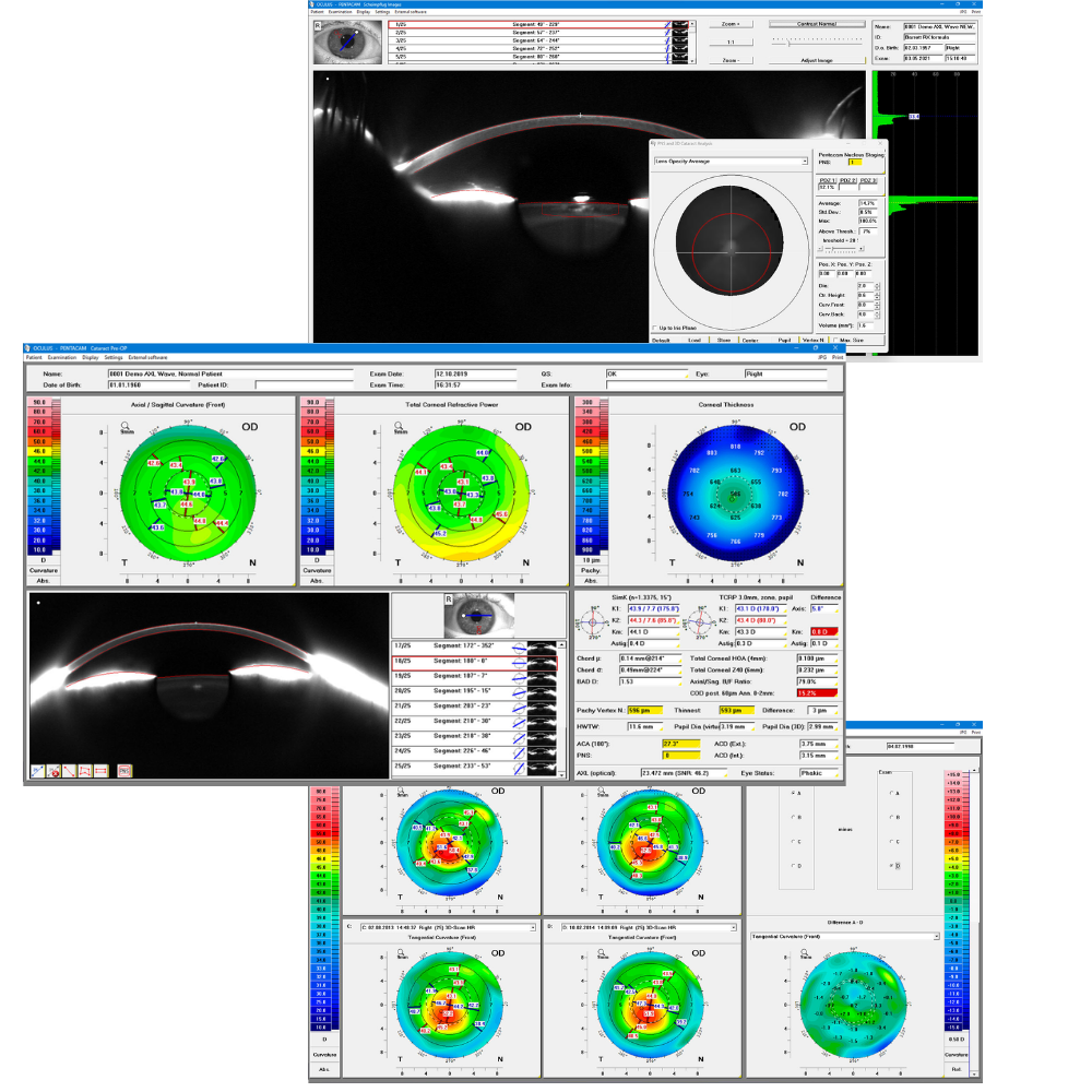 Oculus Pentacam Software